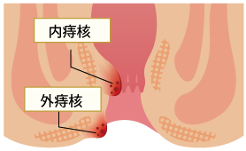 いぼ痔、痔核