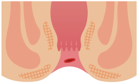 切れ痔、裂肛
