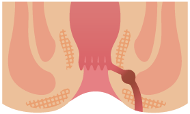 あな痔、痔ろう