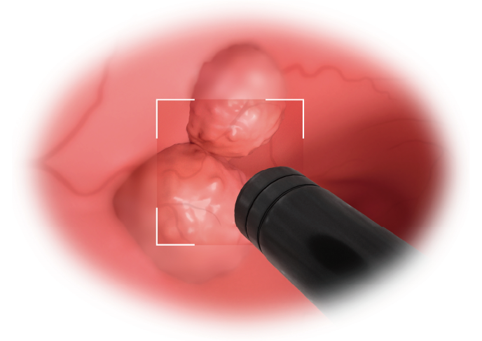高い診断能力で発見できる大腸腺腫